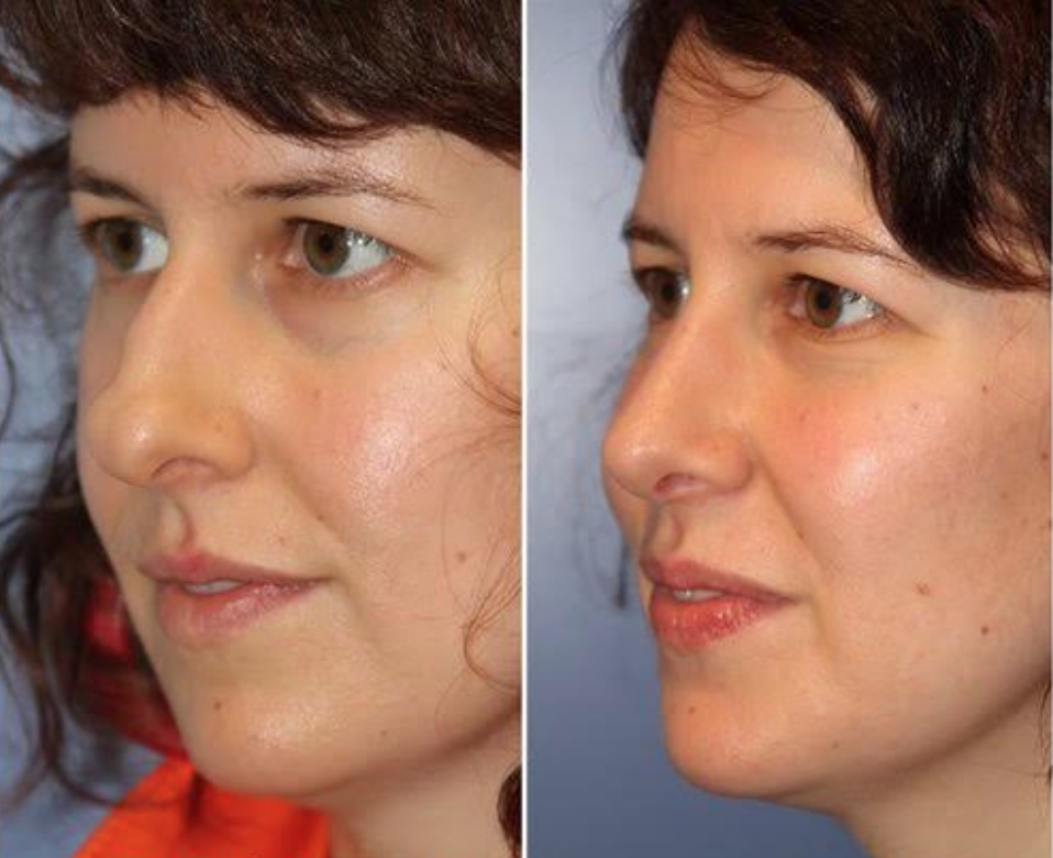 Los Angeles Facial Plastic Surgery - Delivering Natural-Looking Results