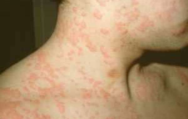 Urticaria Treatment in Delhi