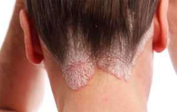 Best psoriasis treatment in Delhi