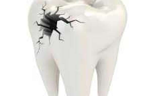 Cracked teeth can cause extreme tooth ache if left untreated