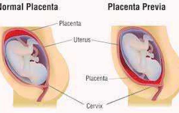 Placenta Previa Treatment In Tirunelveli
