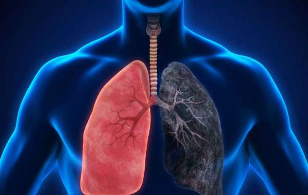 Lung Cancer Treatment in Delhi