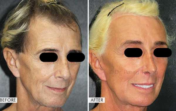 Facial Feminization Surgery Cost in USA, UK and India