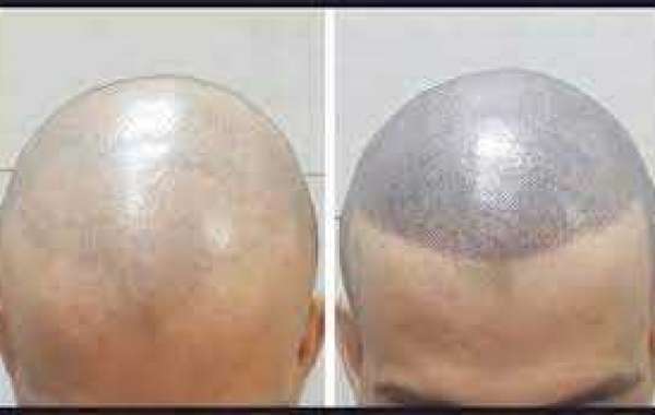 Scalp Micropigmentation Cost