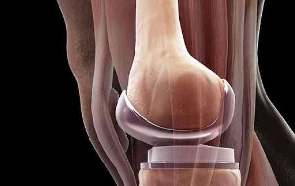 Return to Work after Knee Relief – Cases Perspectives