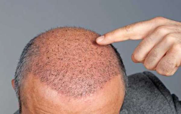 What can you do to get rid of dandruff?
