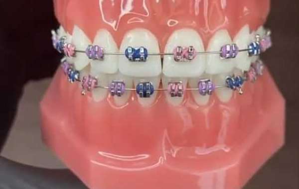 Choose The right Type Of Dental Braces for you
