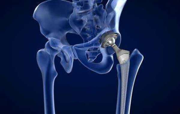 HIP LABRAL TEAR SURGERY UPDATE ONE YEAR POST-SURGERY