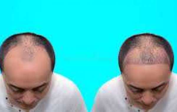 Hair Transplant in Karachi | Best Hair Transplant in Pakistan