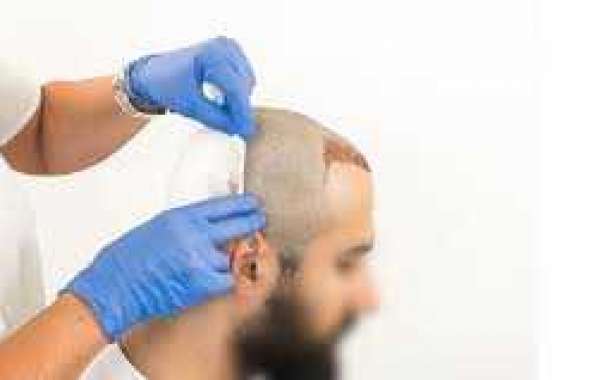 Hair Transplant, Hair Treatment in Islamabad