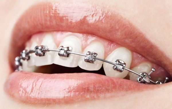 Different Steps Of Teeth Braces