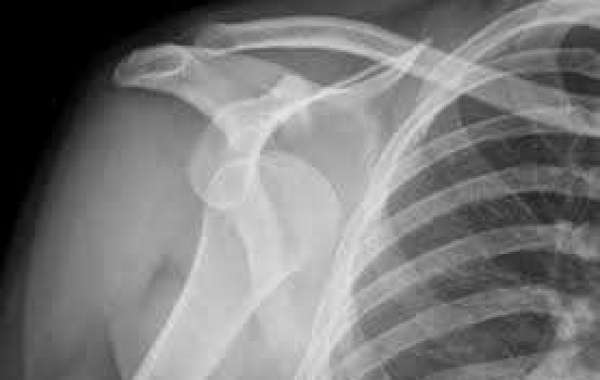 Dislocated Shoulder and Separated Shoulder