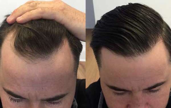 Why FUE Hair Transplant is Considered the Best of All the Hair Loss Treatments?