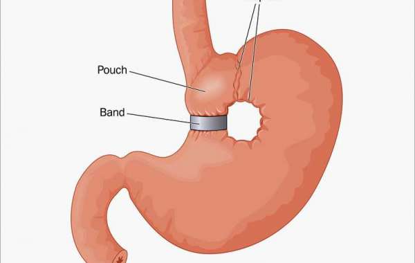 Bariatric Surgery in Dubai