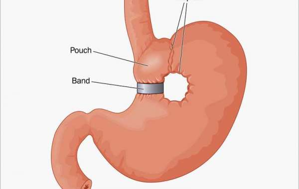 Bariatric Surgery in Dubai