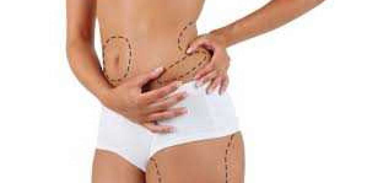 Liposuction in Dubai