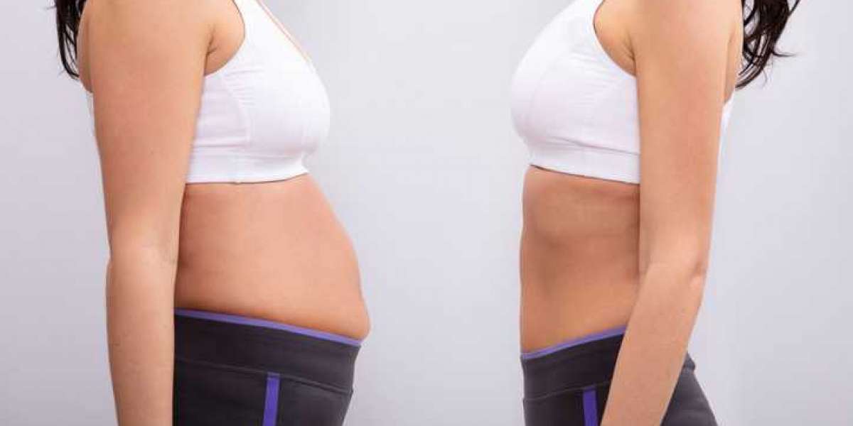 Does CoolSculpting Work on Belly Fat?