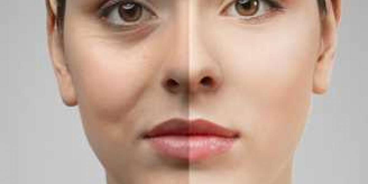 Eyelid Surgery - Why a Laser Eye Lift is Better Than Eye Cream