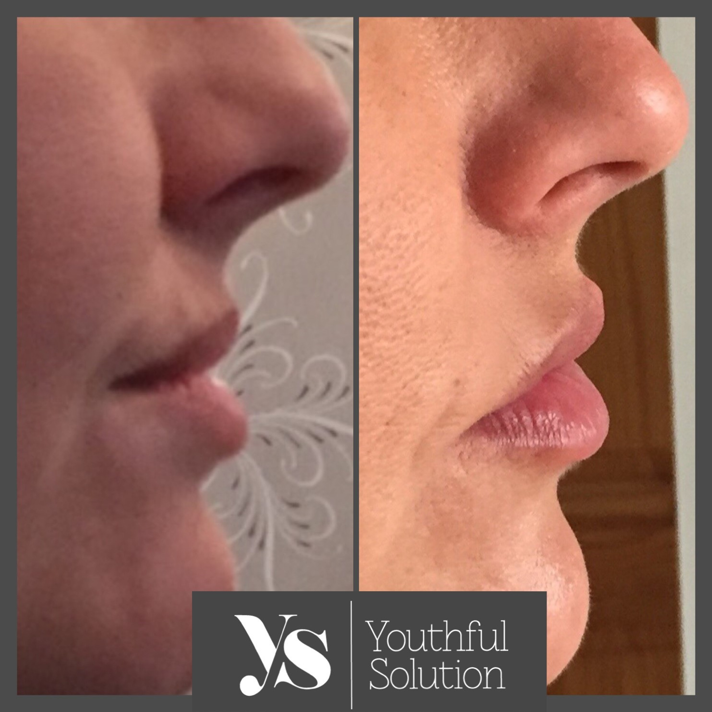 Facial Filler Treatment Doctor In Urmston | Youthful-solution