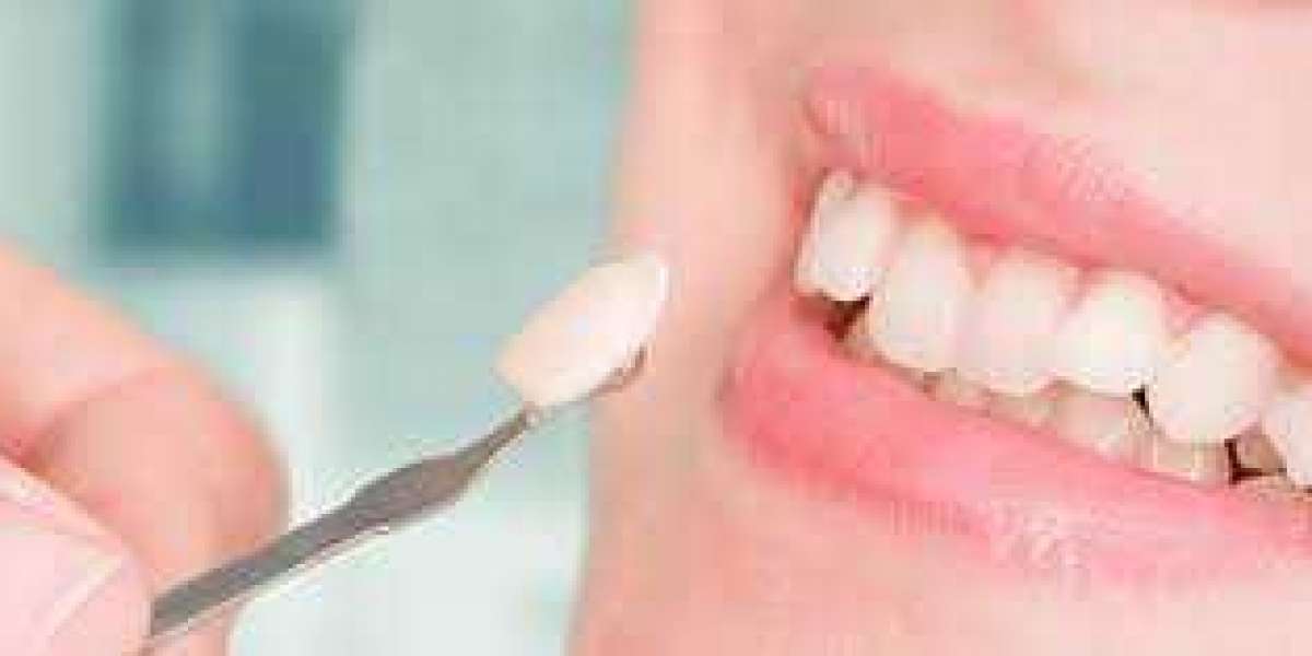 Dental Veneers – Porcelain veneers or Dental Porcelain Laminates