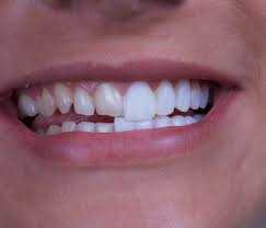 dental veneers brisbane