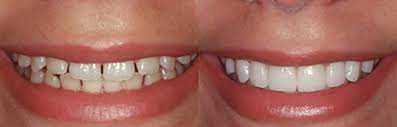 dental veneers