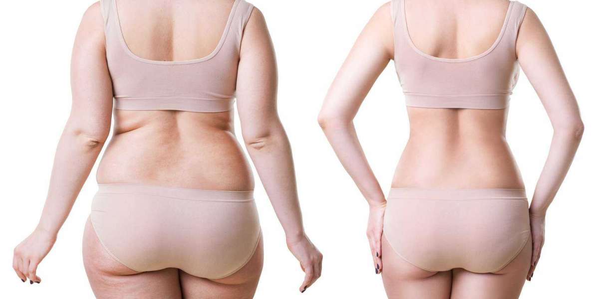 Is Liposuction Surgery in Delhi safe?