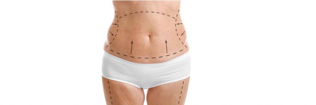 Abdominoplasty or Tummy Tuck Surgery Brazil | Dr. Rodrigo Rosique