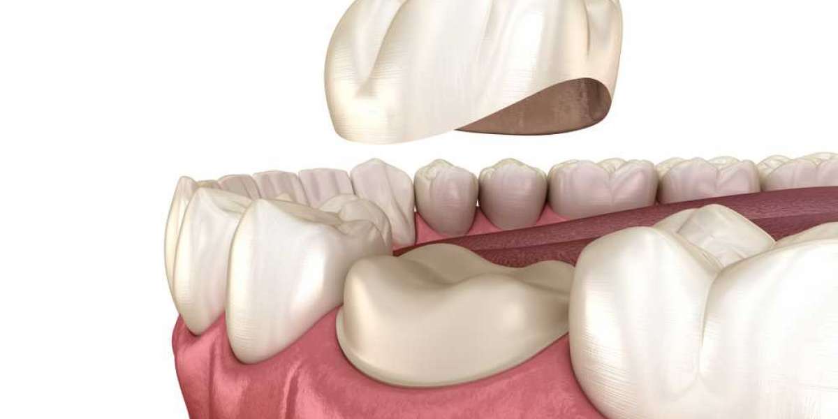 Dental Crowns: Why You Need One For Your Dental Treatment