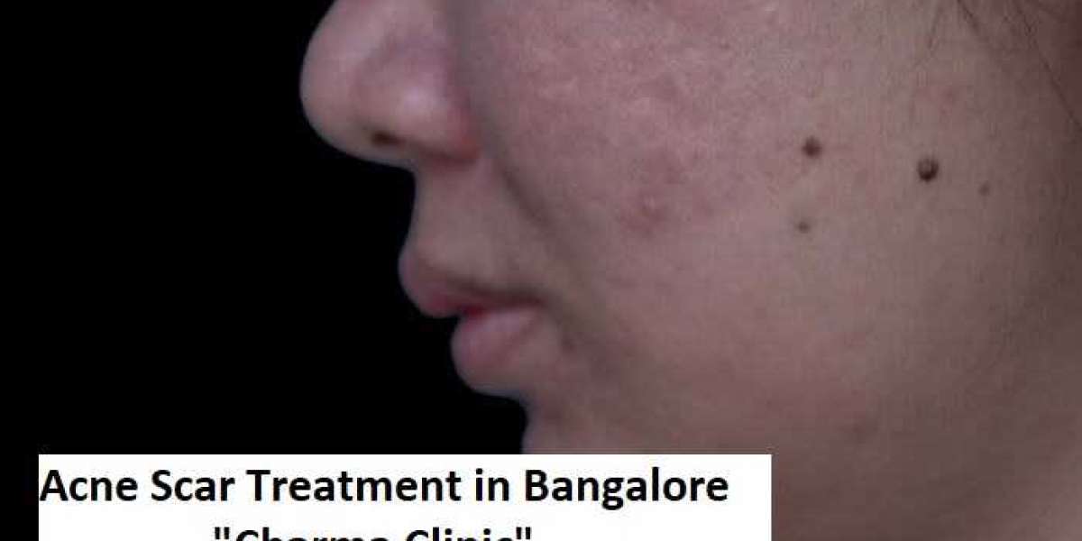 Acne Scars: What's The Best Acne Scar Treatment in Bangalore? - Charma Clinic