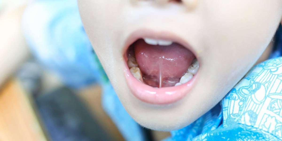 Tongue Tie: What Is It And How Do I Get Rid Of It?