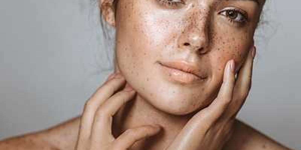 What is Hyperpigmentation?