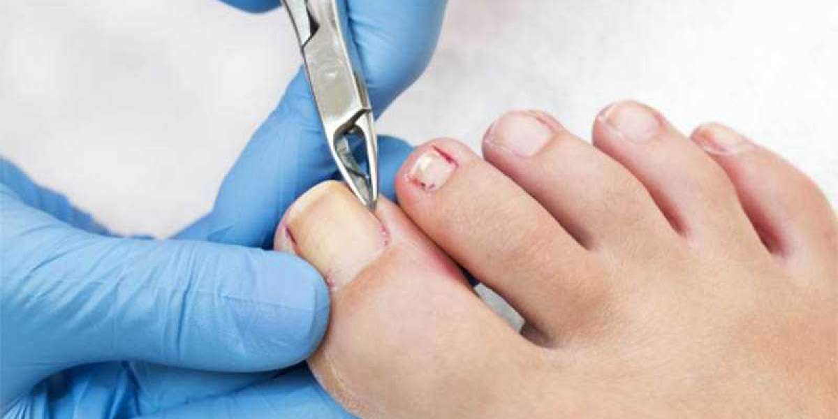 Ingrown Toenail Removal Urgent Care: Pain Relief