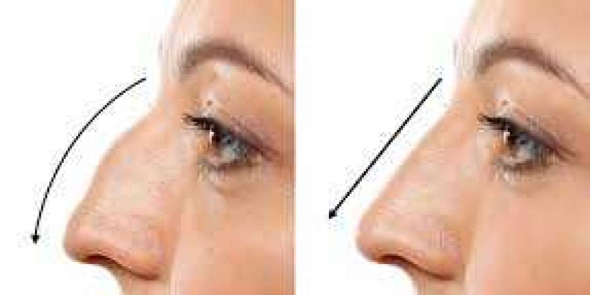 Rhinoplasty Surgery Recovery Time