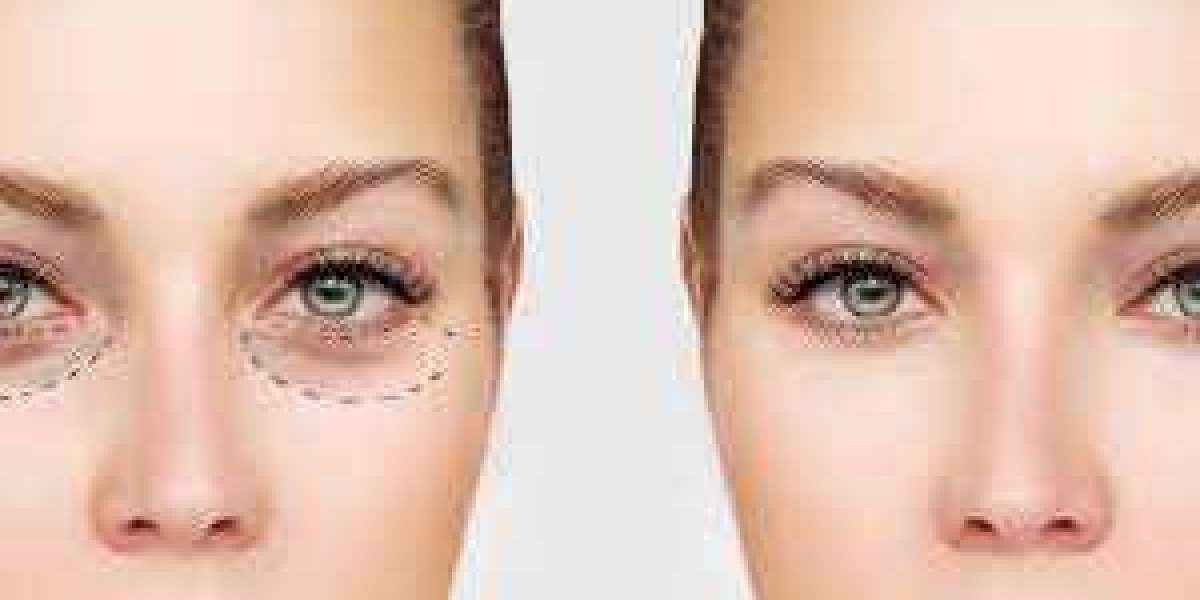 Benefits Of Eye Bag Removal