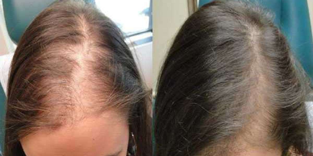 PRP Hair Transplant