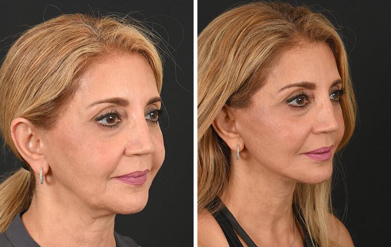 #1 Best Facelift, Forehead Lift Surgery in Jaipur, India | Brow Lift in Jaipur