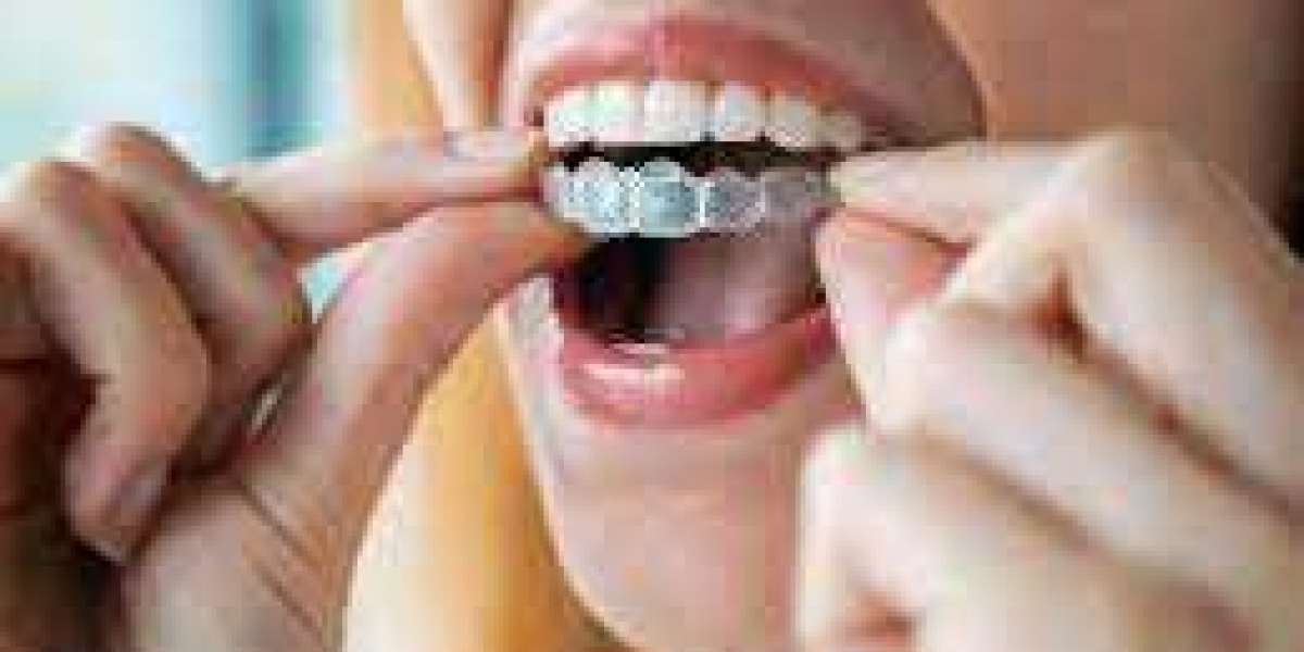 Things You Need to Consider Before Wearing Invisalign Aligners