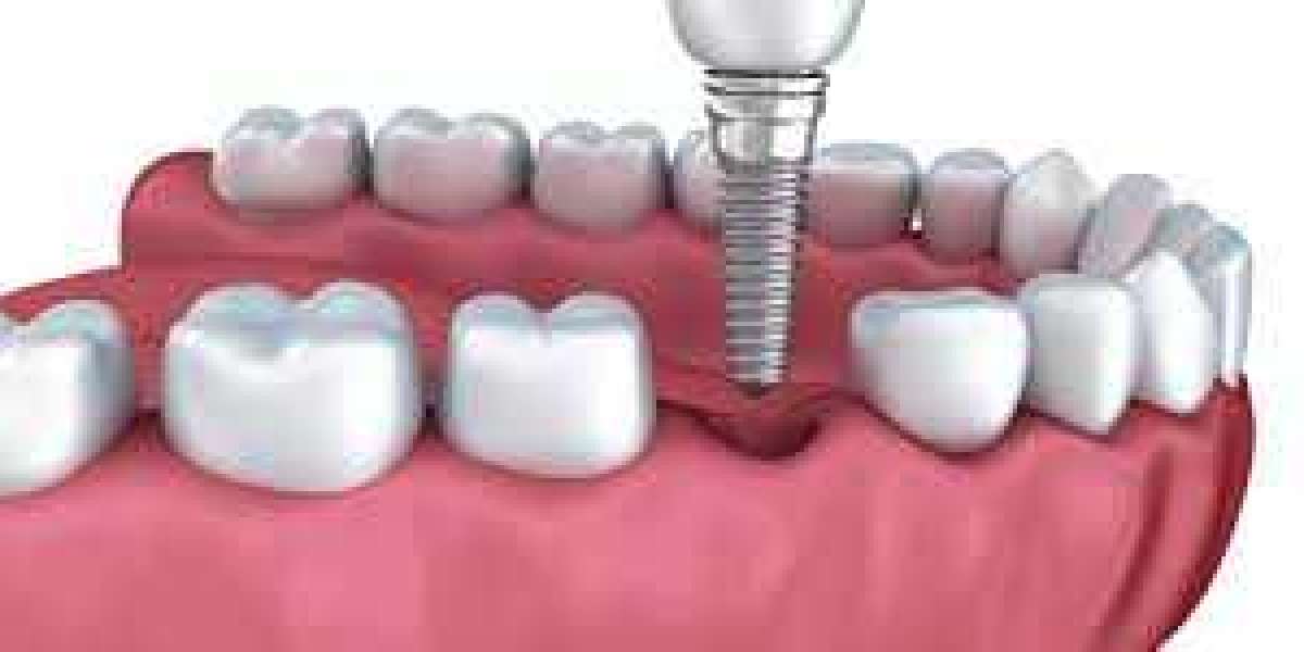 Dental Implant Surgery