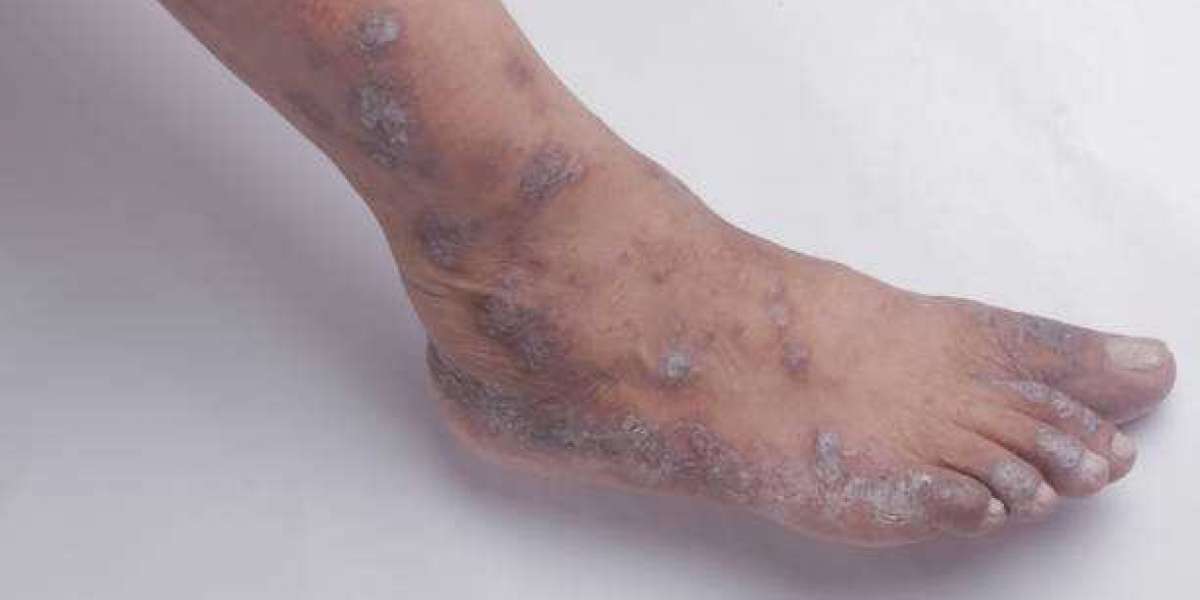 What remedies can I use to treat my fungal infection?