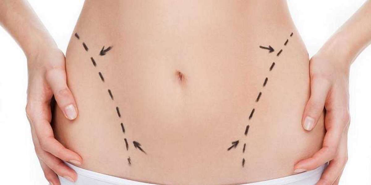 Redefine Your Midriff Tummy Tuck in Riyadh's Realm