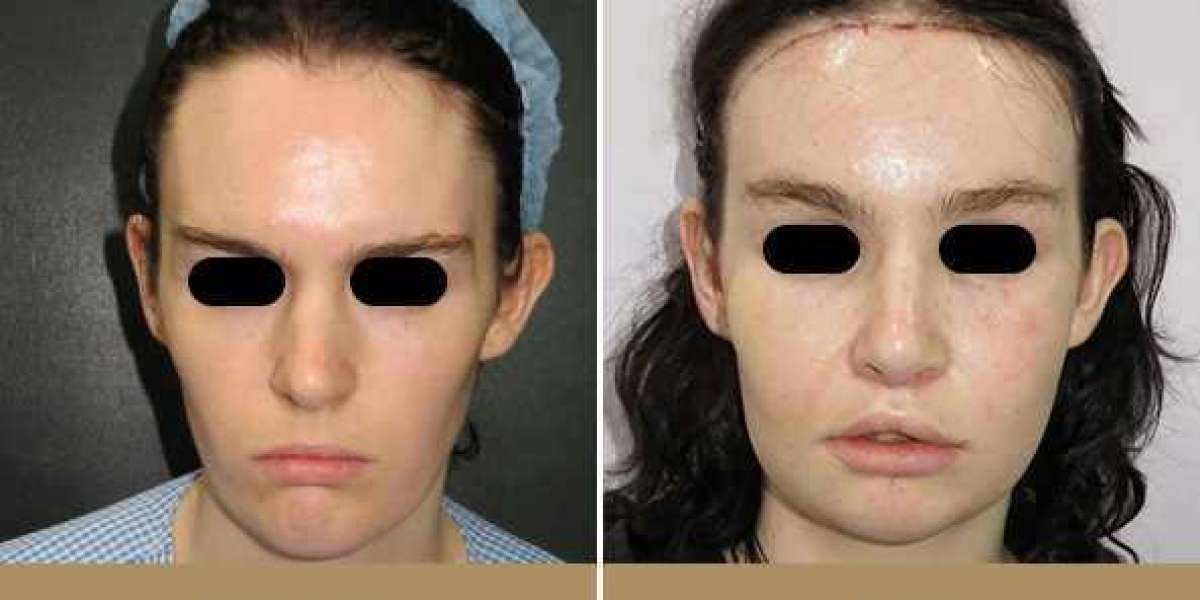 Facial Feminization Surgery Cost in India