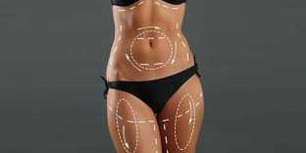 Curves Unveiled Liposuction Brilliance in Riyadh