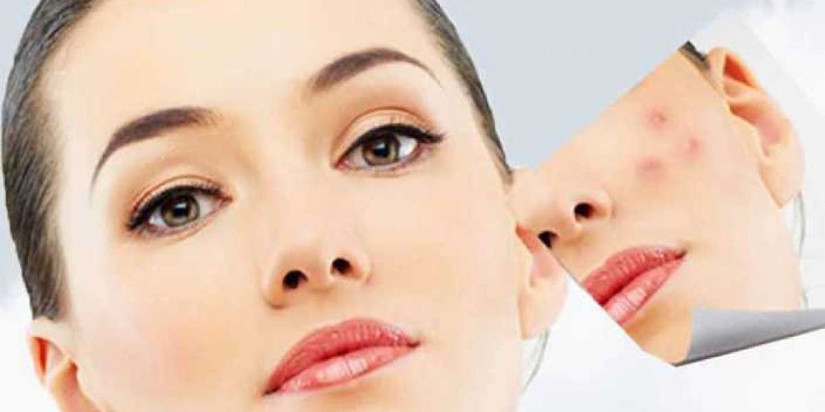 Laser Treatment For Acne Scars