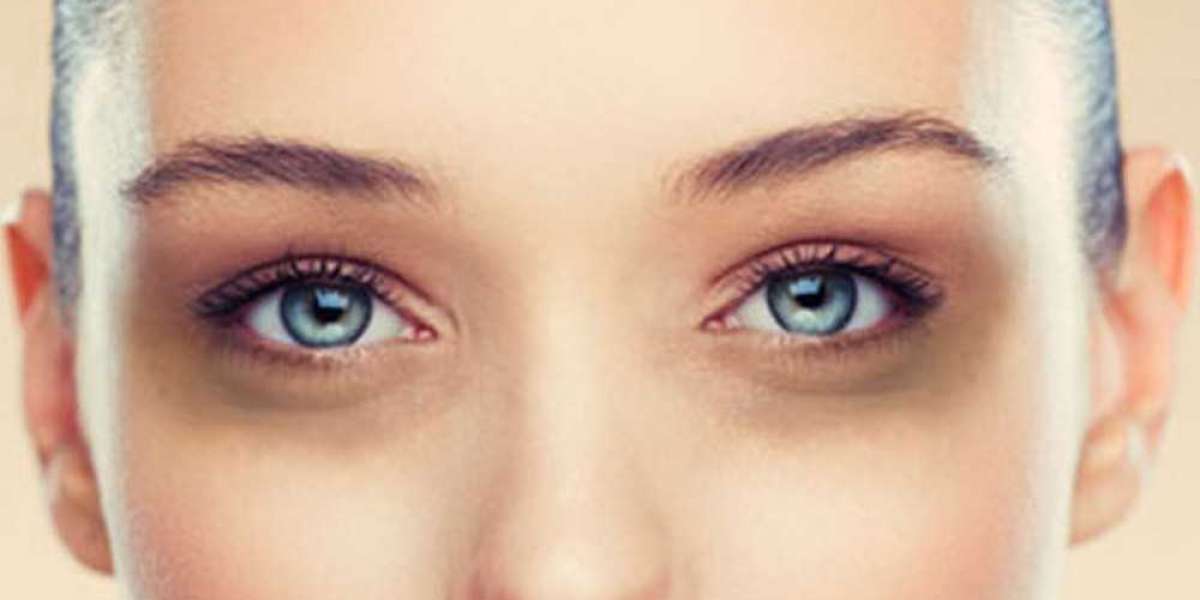 The Difference Between Dark Circles and Under-Eye Bags