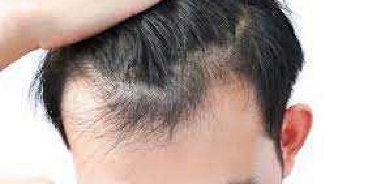 Lavish Lockdown PRP Hair Therapy's Dominance in Riyadh