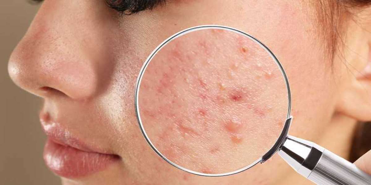 Affordable Acne Solutions Riyadh's Cost-Effective Pimple Treatments