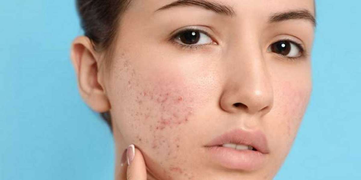 Skin Perfection Riyadh's Best Acne Scar Treatment Solutions