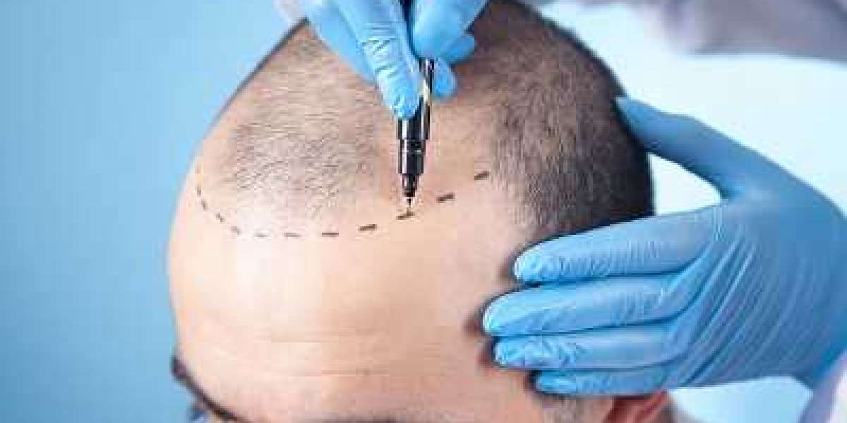 Follicle Focus Top Hair Transplant Clinics in Riyadh