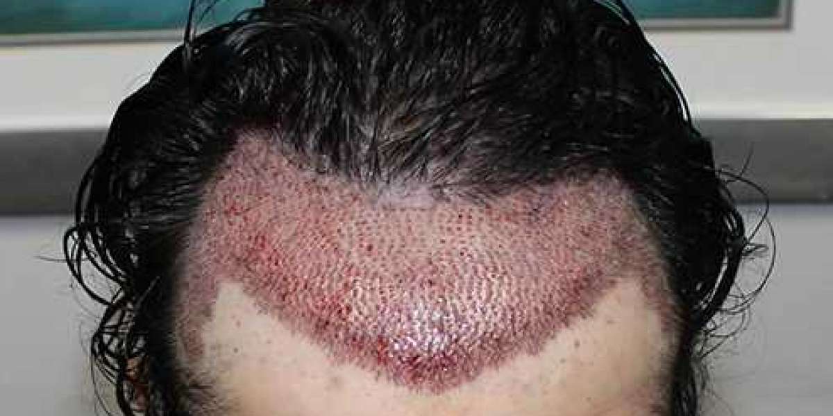 Investing in Confidence Hair Transplant Costs in Riyadh